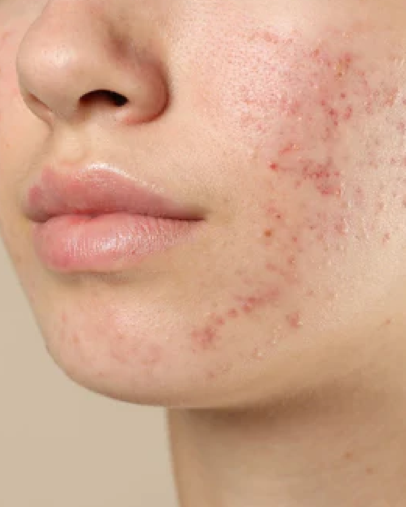 Acné e imperfecciones